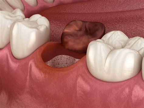 Pictures Of Tooth Extractioninfection