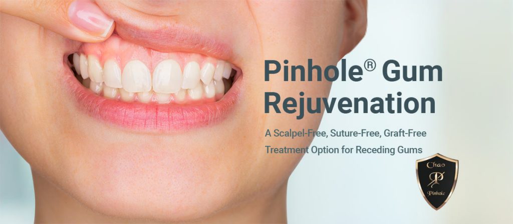 Pinhole Dental Treatment