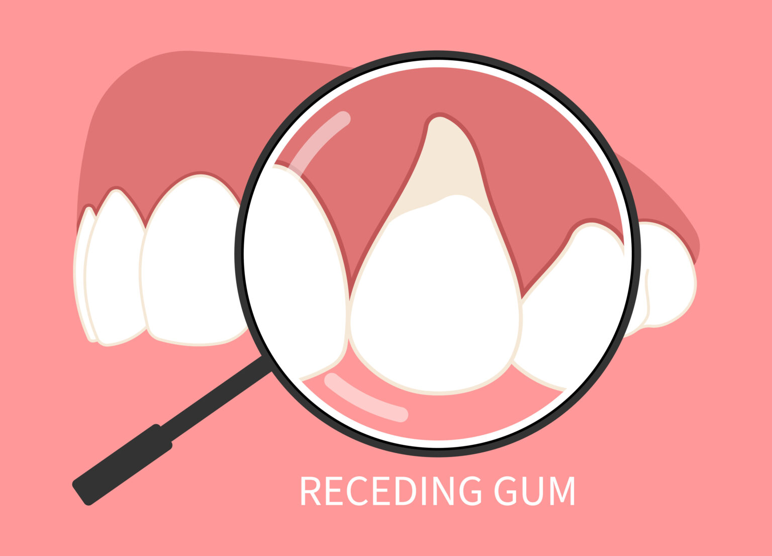 Pinhole Gum Graft