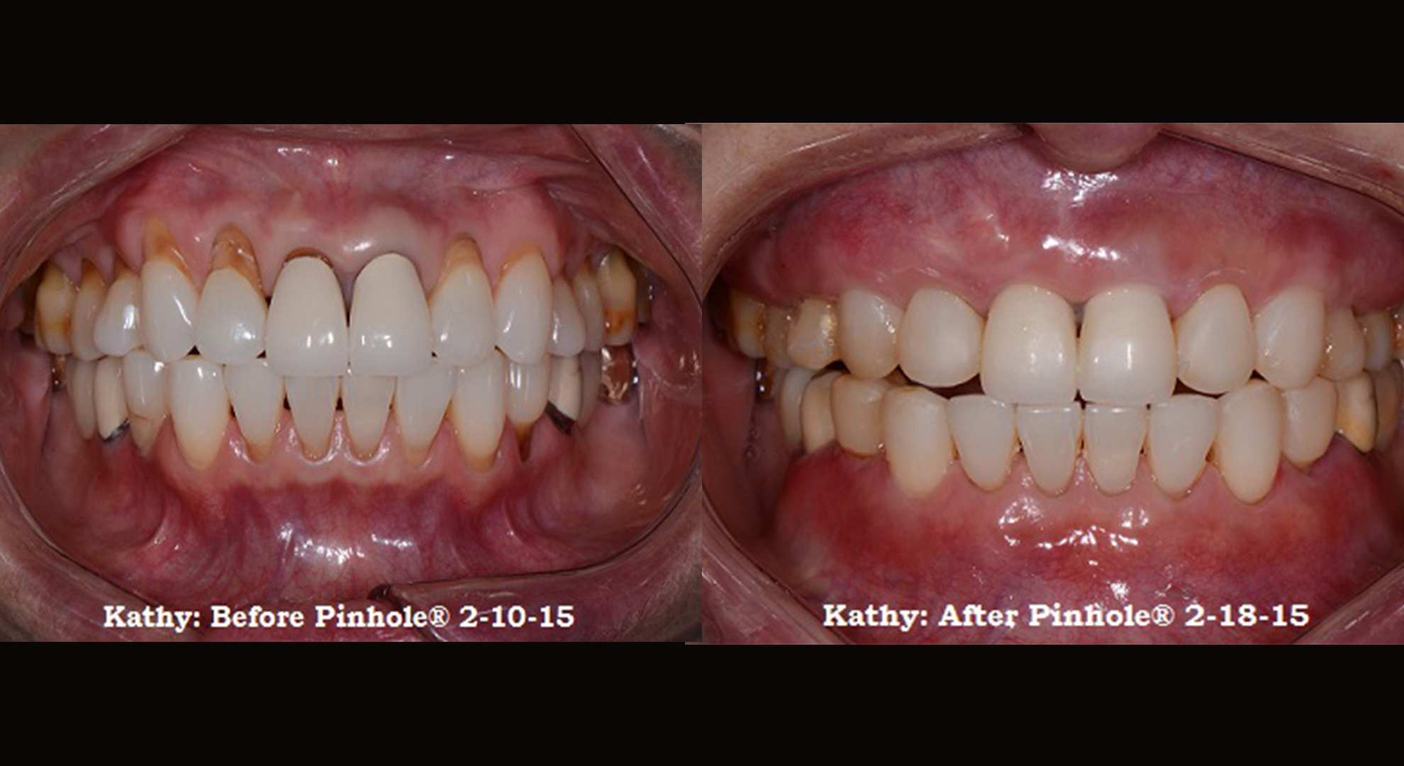 Pinhole Gum Procedure