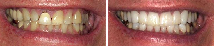 Porcelain Crowns Whitening Options