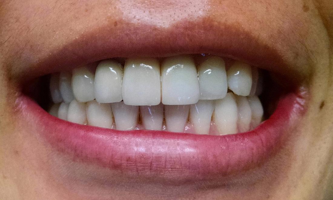 Porcelain Dental Crown Single Front Tooth Crown Before And After Porcelain Dental Crown Single Front Tooth Crown Before And After