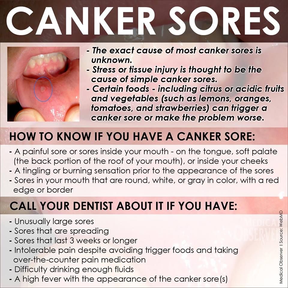 Pregnancy Canker Sores: Causes And Cures
