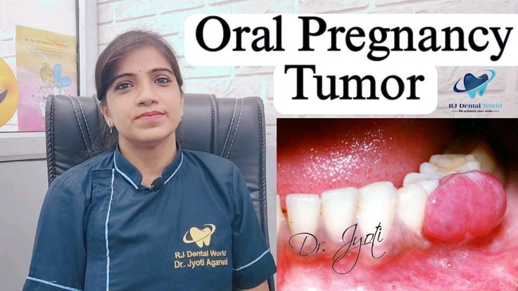 Pregnancy Tumor Mouth