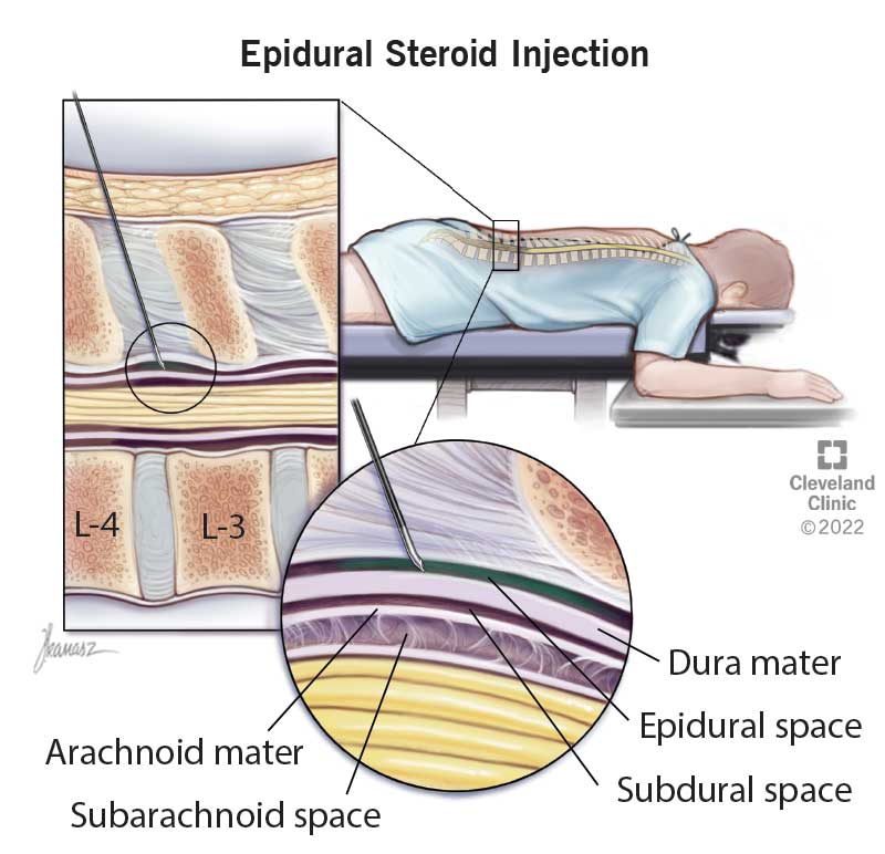 Preparation For Epidural Steroid Injection