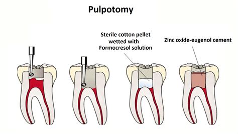 Primary Tooth Pulpotomy