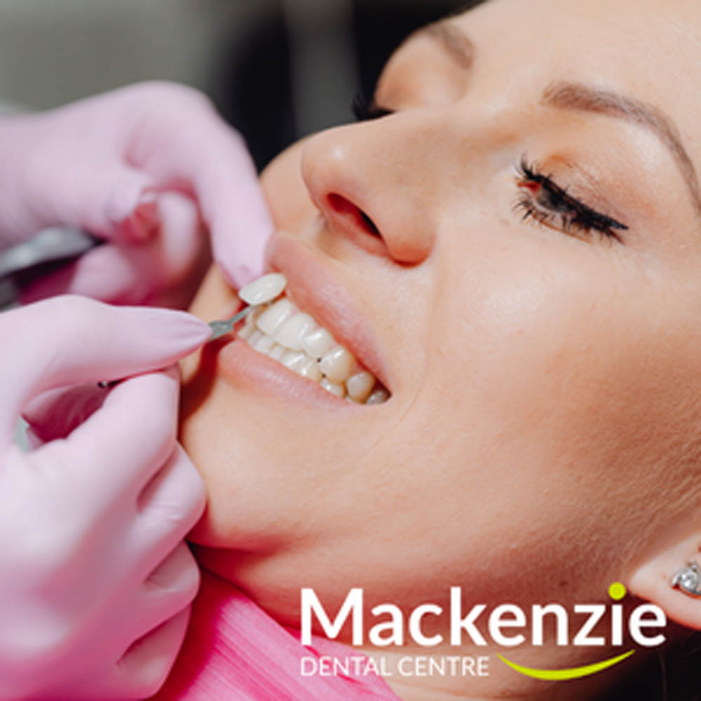 Pro And Cons Of Veneers Pro And Cons Of Veneers