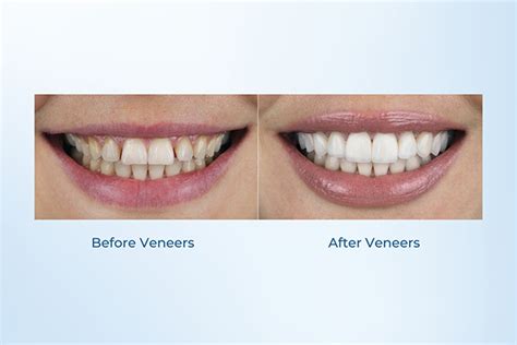 Pros And Cons Of Veneers