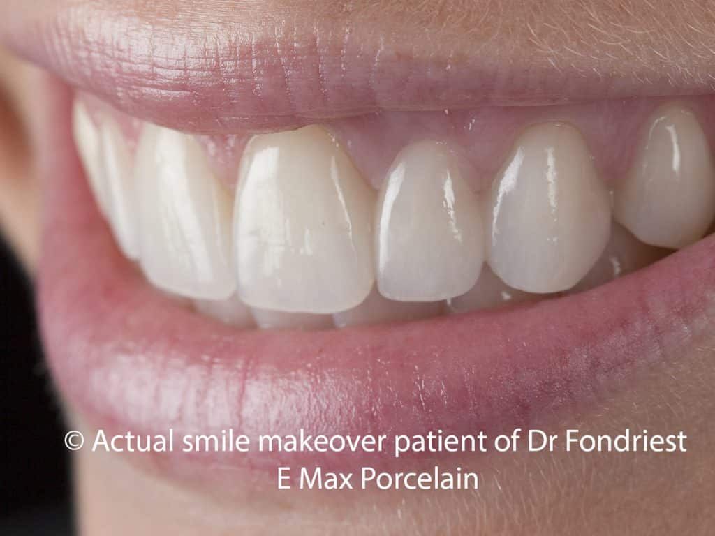 Quality Dental Bridge Pictures And Descriptions Of Types Dentists Can Quality Dental Bridge Pictures And Descriptions Of Types Dentists Can