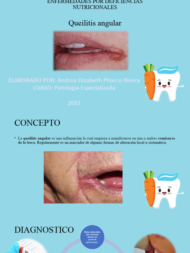 Queilitis Angular Tratada