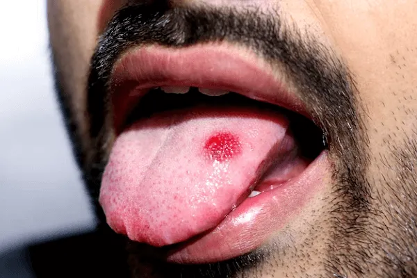 Quemada En La Lengua