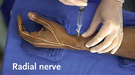 Radial Nerve Block Tutorial: Master Injection Techniques