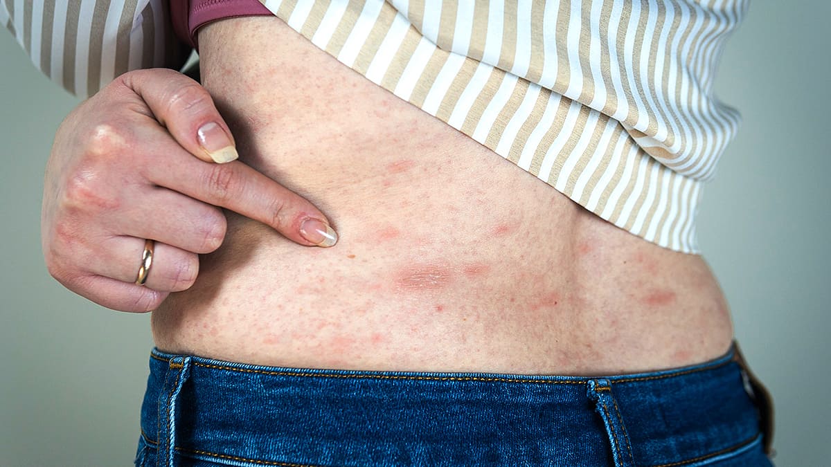 Rash On Stomach Relief: Causes Identified