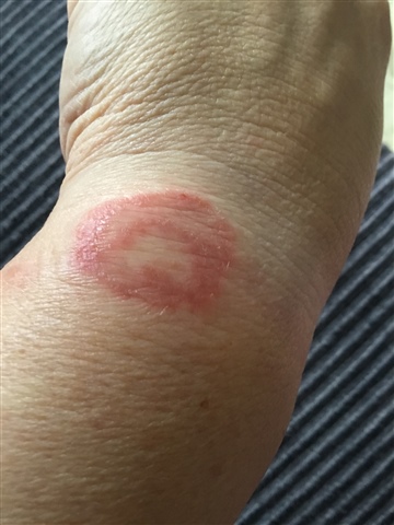 Rash On Wrist From Watch