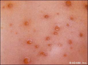 Rash With Flu Shot