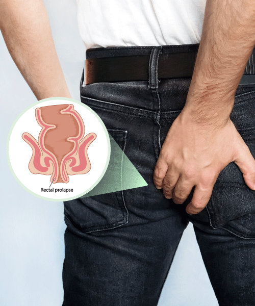 Rectal Prolapse Pictures
