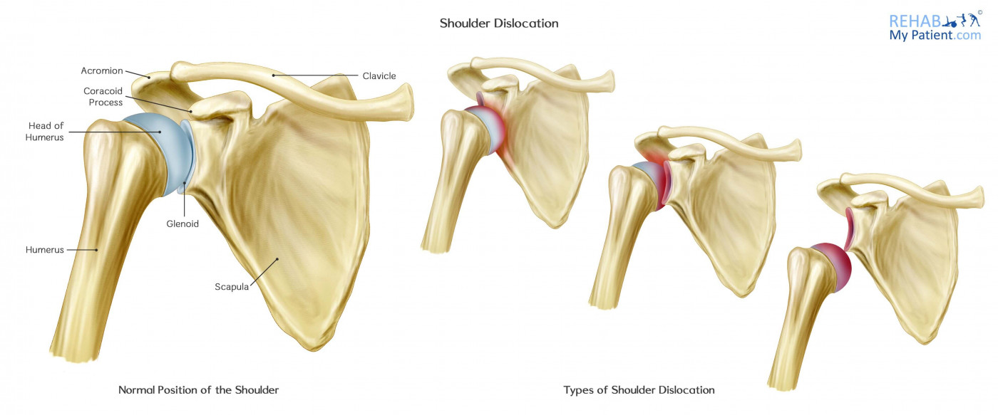 Reduce Shoulder Dislocation