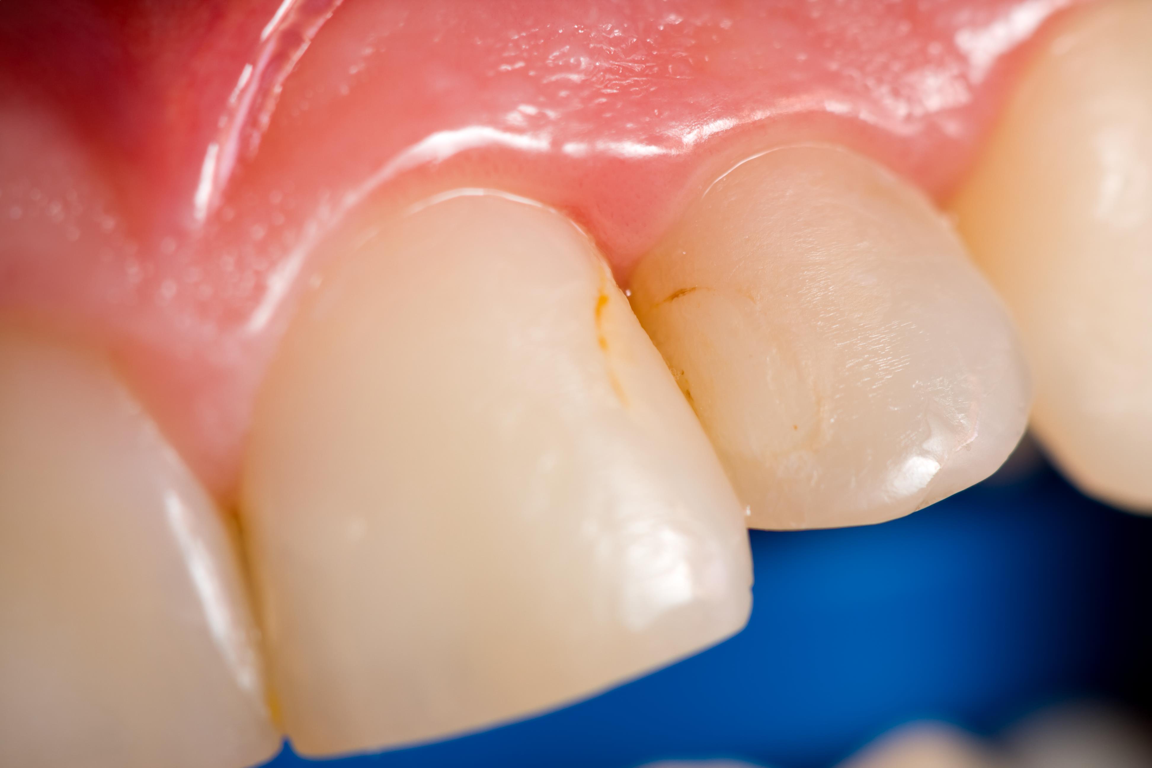 Remove Brown Spots On Teeth