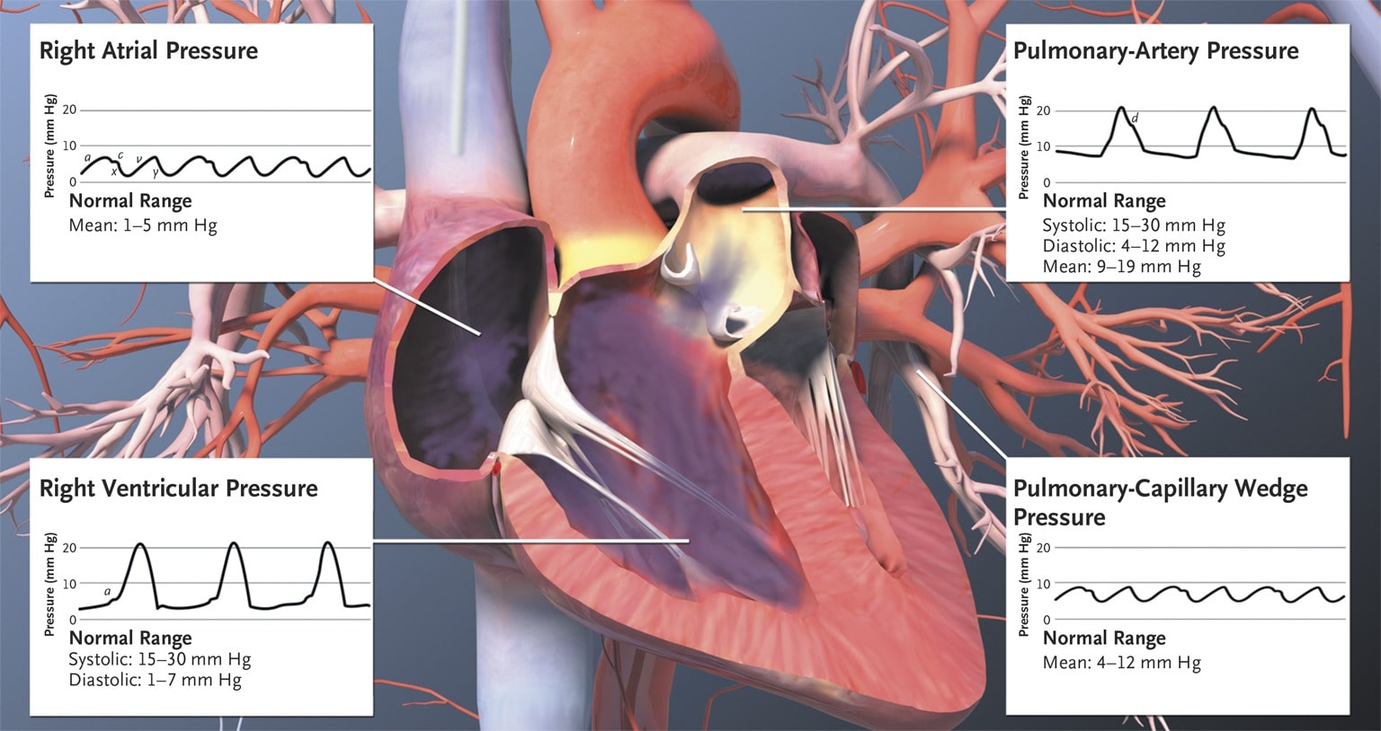 Right Atrial Pressure Range Right Atrial Pressure Range