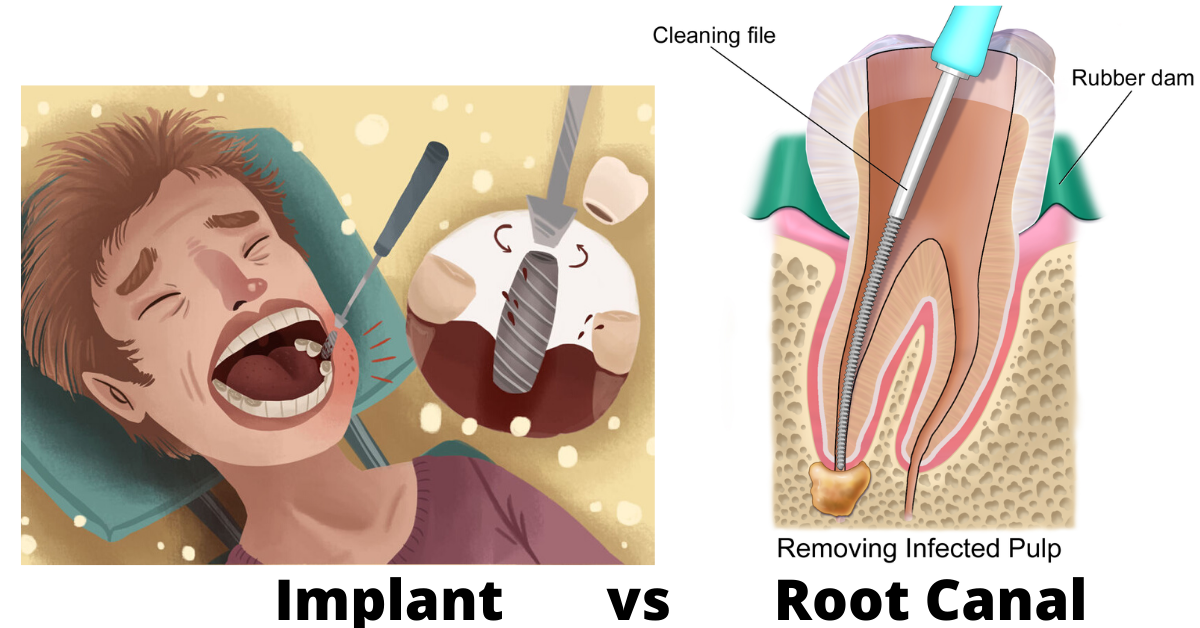Root Canal And Implant
