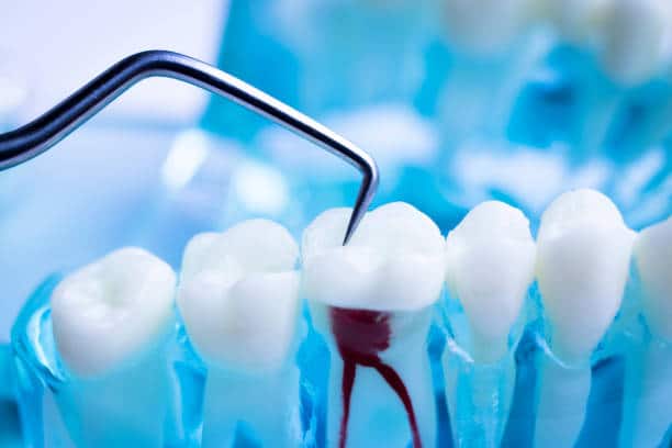 Root Canal Tips For A Smooth Healing Process Independence Dental Root Canal Tips For A Smooth Healing Process Independence Dental