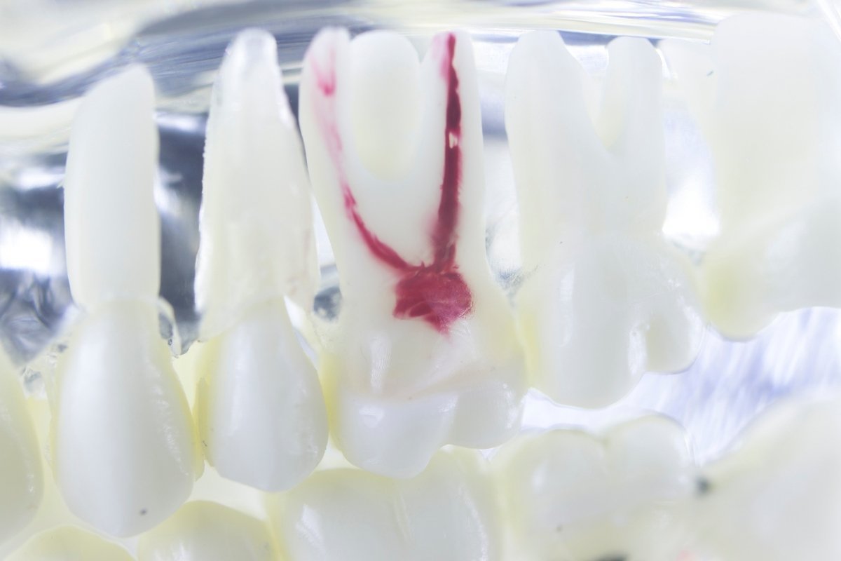 Root Canals Bad