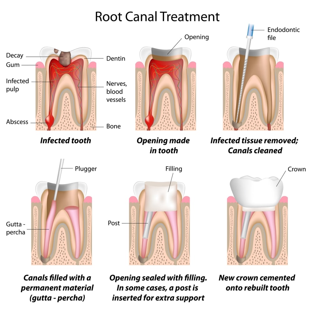 Root Canals In Bloomfield Nj Root Canal Therapy Bloomfield Dental Root Canals In Bloomfield Nj Root Canal Therapy Bloomfield Dental