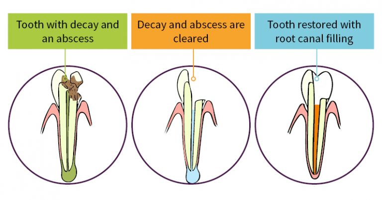 Root Resorption: Repair Damaged Teeth Quickly