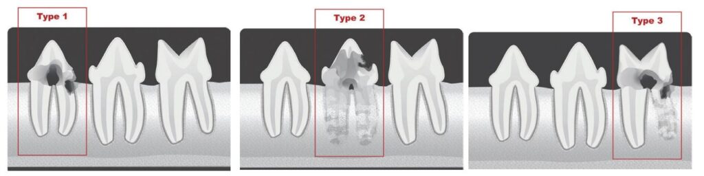 Root Resorption Treatment: Stop Tooth Loss Now