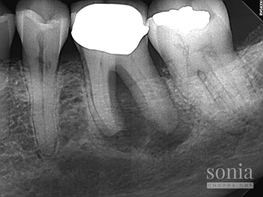 Root Resorption Treatment