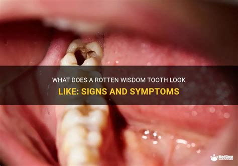Rotten Wisdom Tooth Cavity
