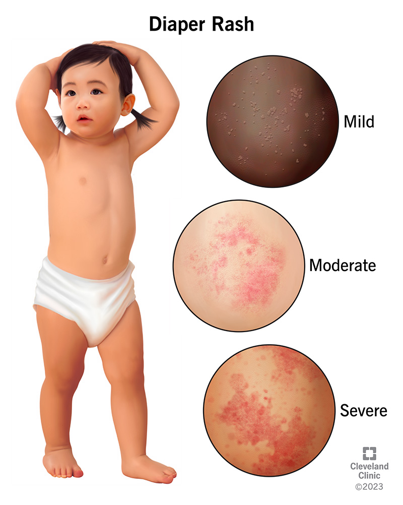 Rsv Diaper Rash Relief: Symptoms & Treatment Rsv Diaper Rash Relief: Symptoms & Treatment