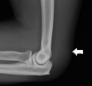 Ruptured Tricep Tendon Symptoms