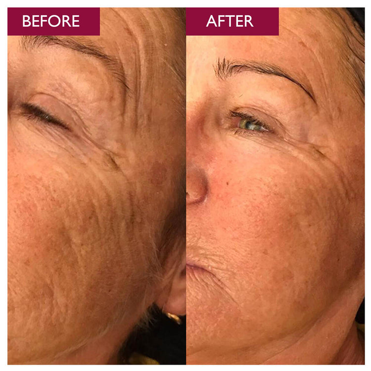 Salicylic Acid Wrinkles