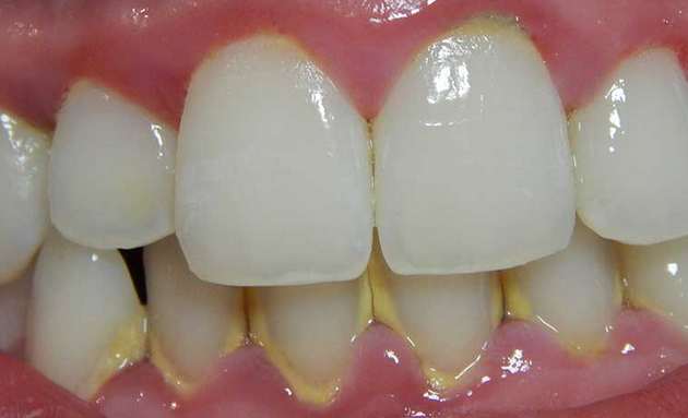 Salt Rinse: Heal Gum Infection Naturally