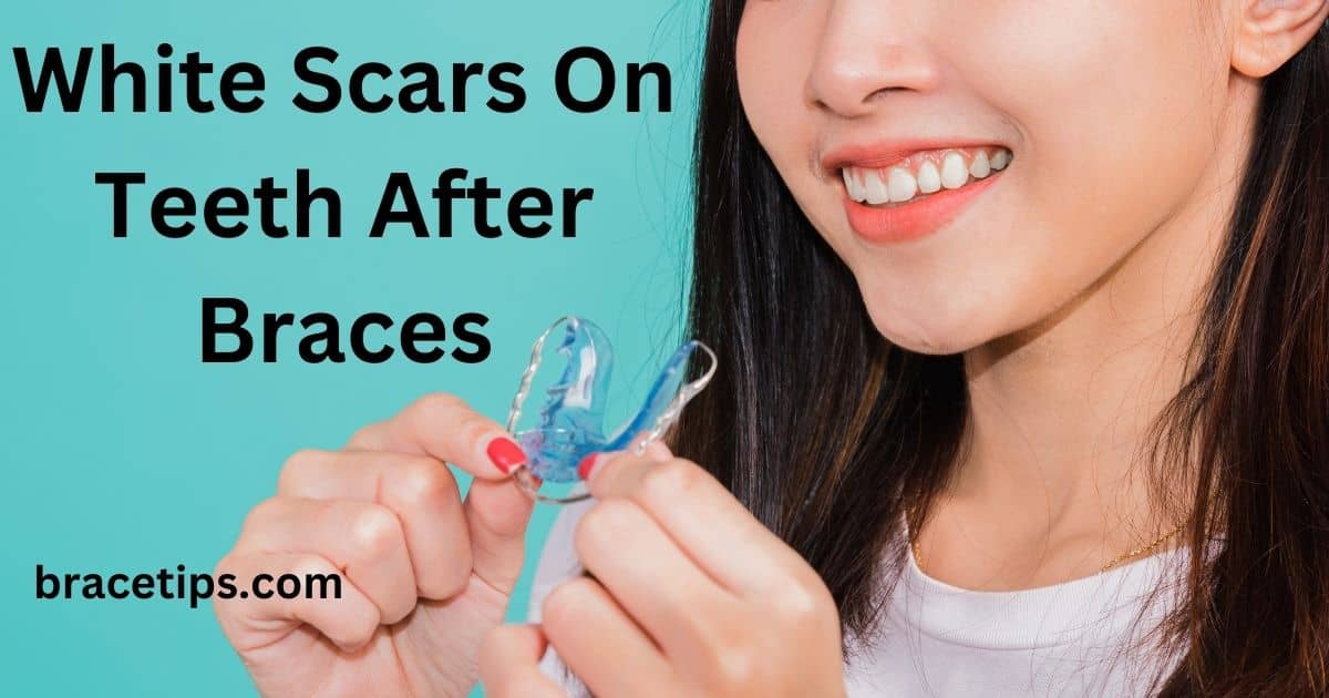 Scars On Teeth From Braces