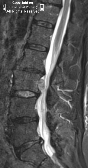 Sequestered Disk Herniation