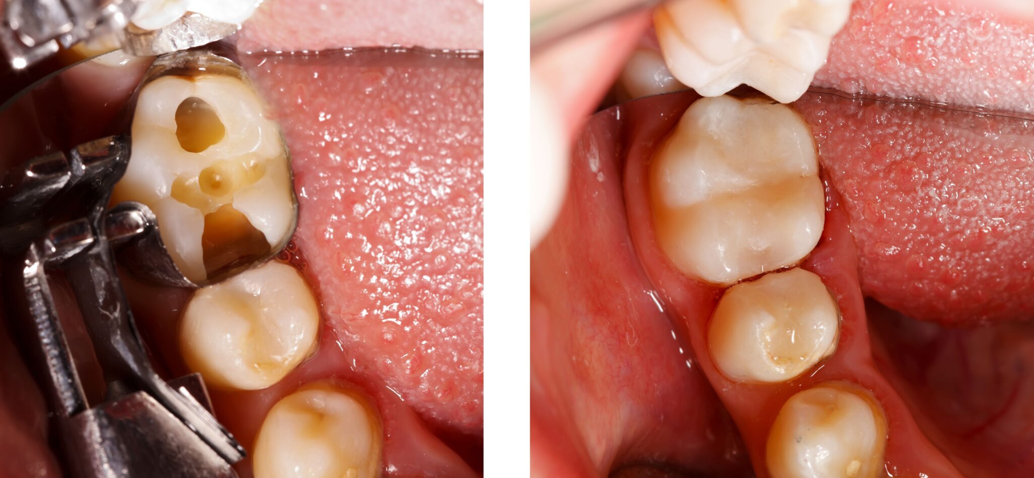 Should Fillings Hurt After
