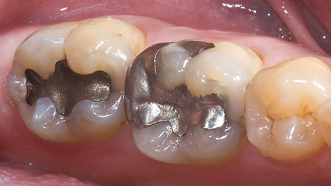 Silver Dental Filling Silver Dental Filling
