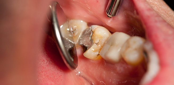 Silver Filling Removal Neutral Bay Shore Dental Silver Filling Removal Neutral Bay Shore Dental