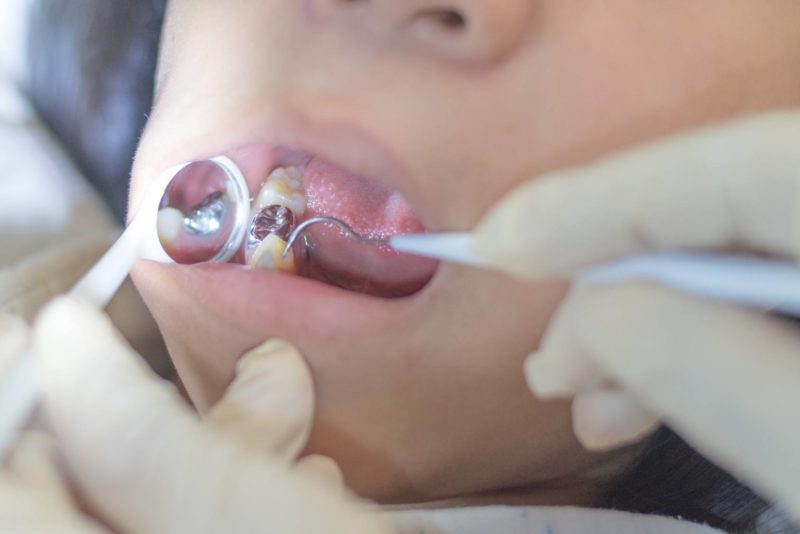 Silver Fillings Vs White Fillings Advanced Family Dentistry Tucson Silver Fillings Vs White Fillings Advanced Family Dentistry Tucson