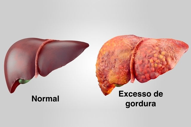 Sintomas De Gordura No Figado