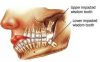 Smelly Wisdom Tooth
