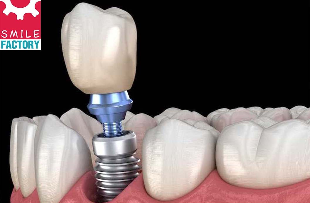 Smilefactory Best Dentists In North Goa Dental Implants Smilefactory Best Dentists In North Goa Dental Implants