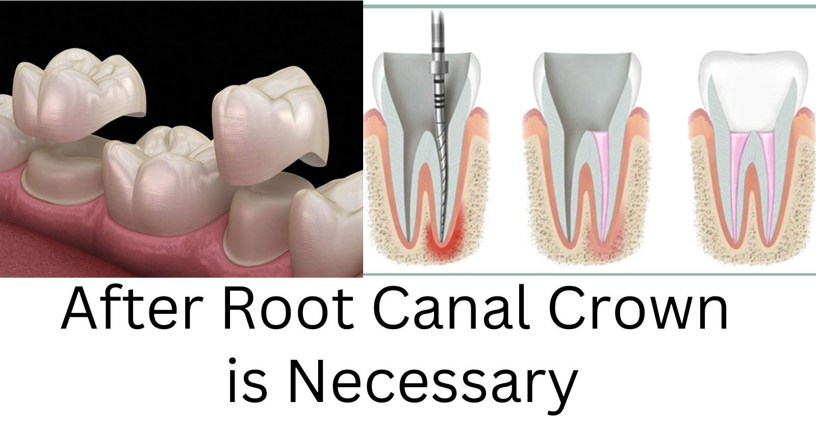 Soft Food After Root Canal