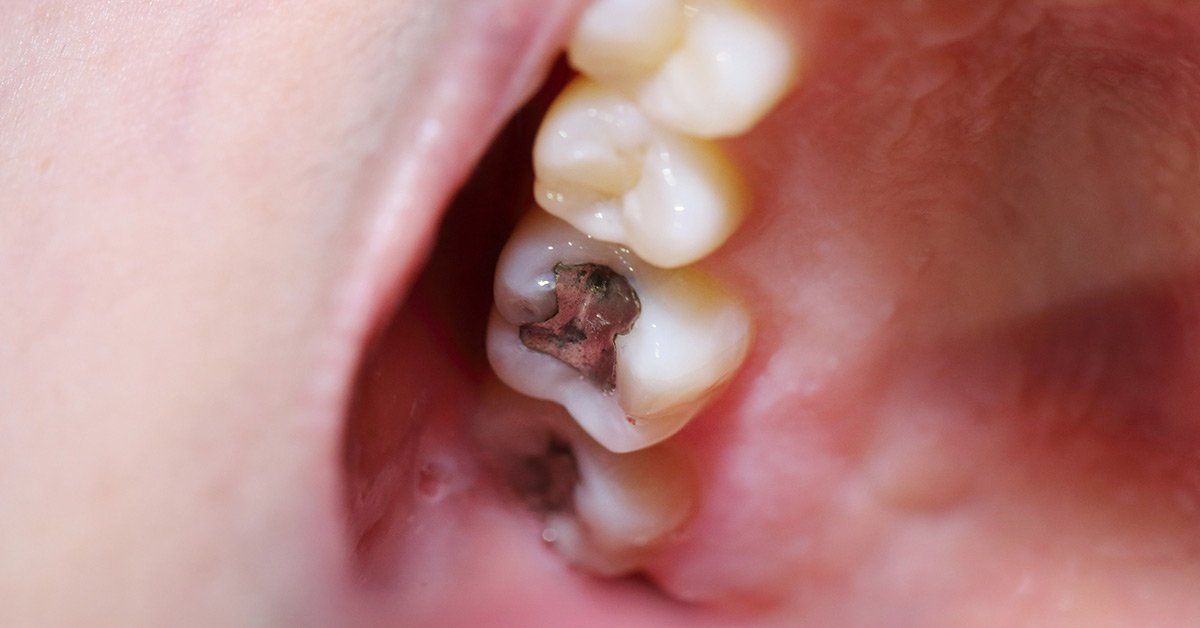 Soreness After Filling Cavity
