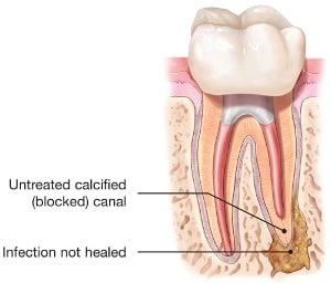 Split Tooth Root: Relief Through Endodontic Treatment