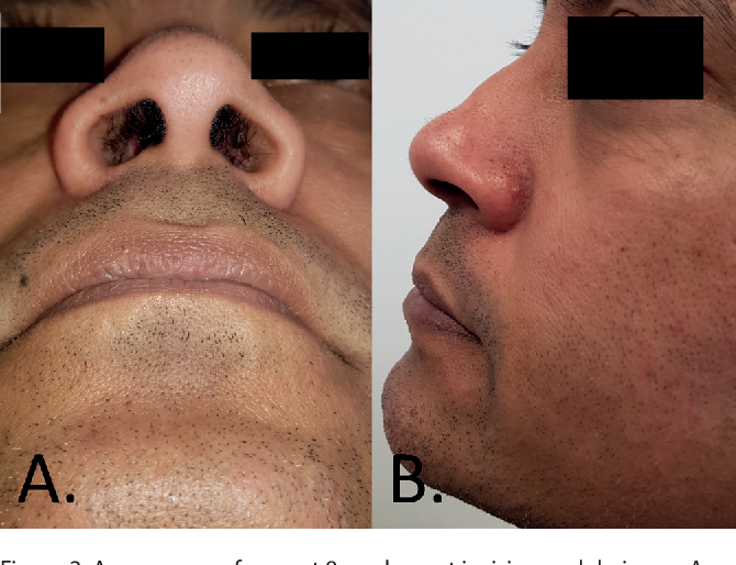 Spontaneous Nasal Septal Abscess Presenting As Complete Nasal Obstruction Spontaneous Nasal Septal Abscess Presenting As Complete Nasal Obstruction