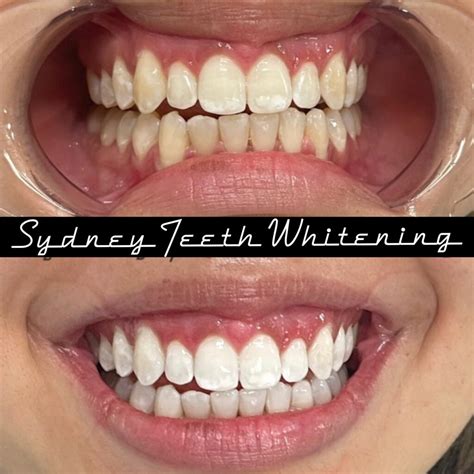Spots On Teeth After Whitening Spots On Teeth After Whitening