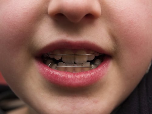 Spring Retainer Orthodontics Spring Retainer Orthodontics